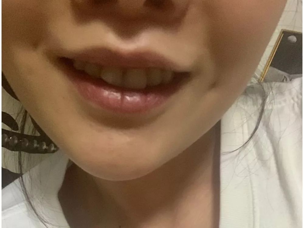 大龄整牙,错过生长发育期怎么办