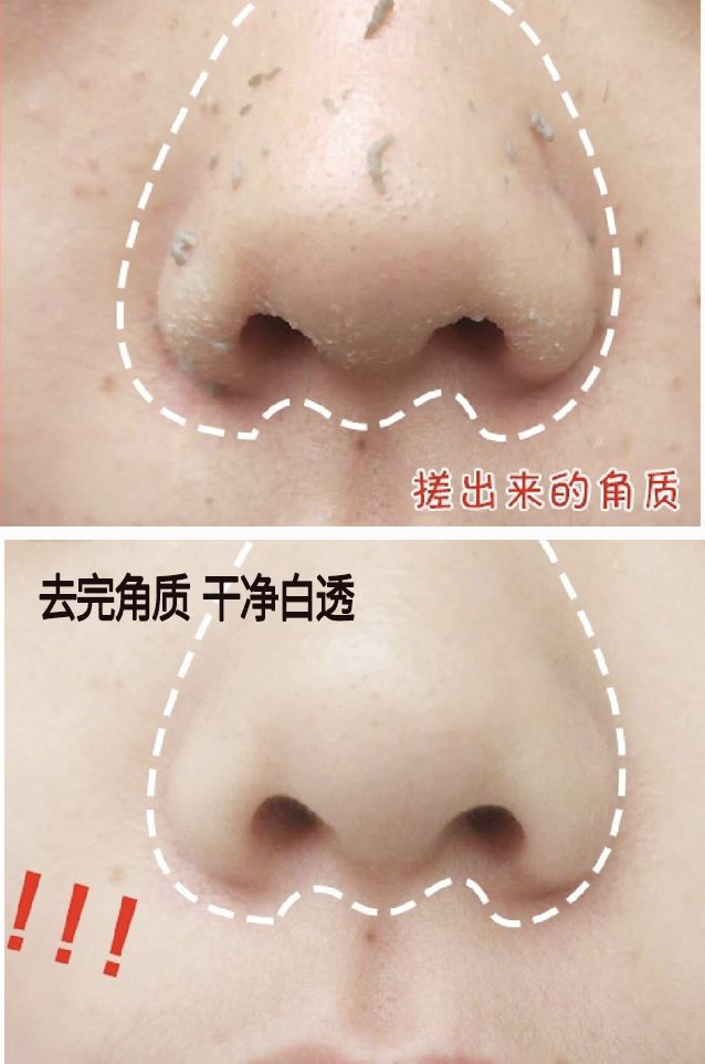 脸上搓出3斤泥！难怪又黄又暗又黑头！10秒给脸蛋“剥壳”，厉害