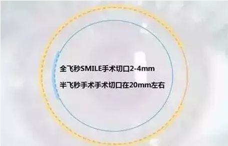 近视1200度可以做飞秒激光手术吗,近视手术全激光和飞秒有什么区别