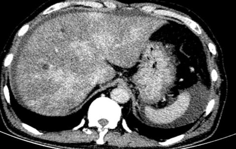 土三七中毒治好后肝能恢复正常吗,土三七中毒所致的肝损害的治疗