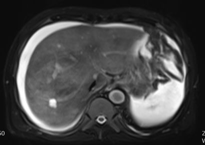 土三七中毒治好后肝能恢复正常吗,土三七中毒所致的肝损害的治疗