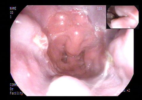 土三七中毒治好后肝能恢复正常吗,土三七中毒所致的肝损害的治疗