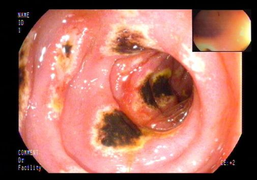 土三七中毒治好后肝能恢复正常吗,土三七中毒所致的肝损害的治疗