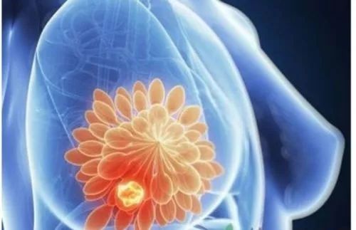 乳房实性结节什么意思,乳房结节有点大不动手术要紧吗