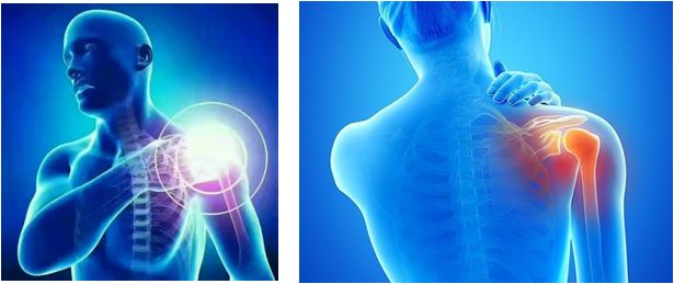 肩周炎讨人嫌,轻轻一灸治疗解烦忧