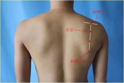 肩周炎讨人嫌,轻轻一灸治疗解烦忧