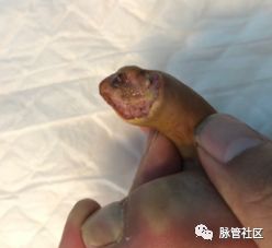 足部溃疡是什么症状,杏林微科普冬季手足皲裂怎么办