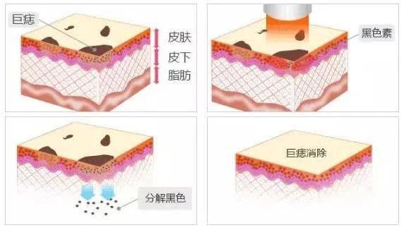全智贤的痣在哪边,全智贤鼻头的痣好不好