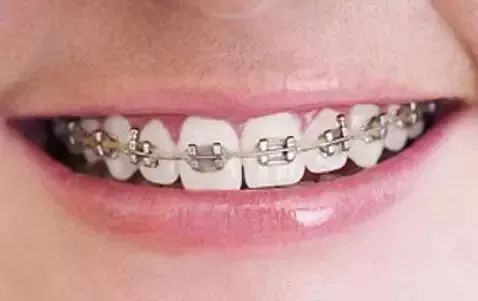 暑期矫牙季来啦你准备好了吗,暑期矫牙特惠