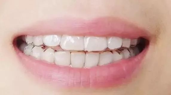 暑期矫牙季来啦你准备好了吗,暑期矫牙特惠