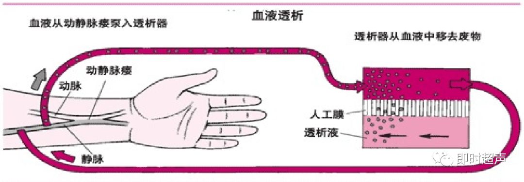 血液透析动静脉造瘘的超声评价