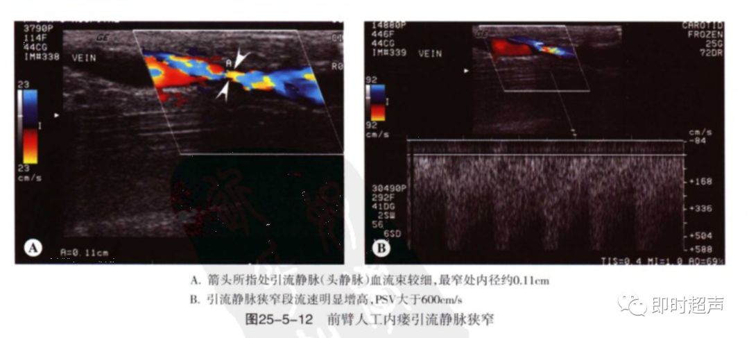 血液透析动静脉造瘘的超声评价