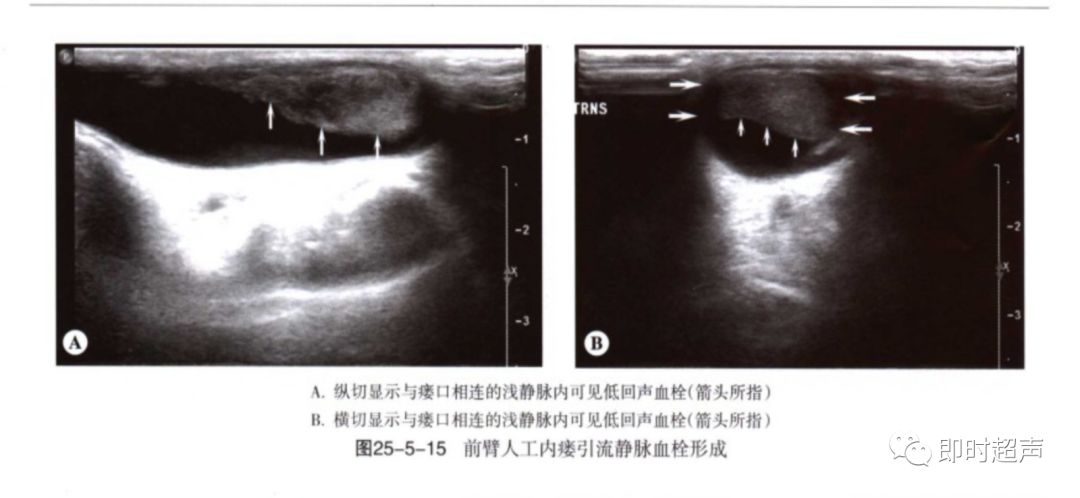 血液透析动静脉造瘘的超声评价