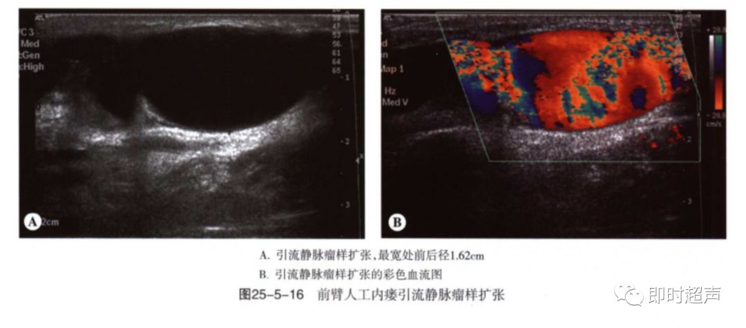 血液透析动静脉造瘘的超声评价