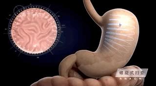 中国磁控胶囊胃镜临床应用指南书,磁控胶囊胃镜临床意义