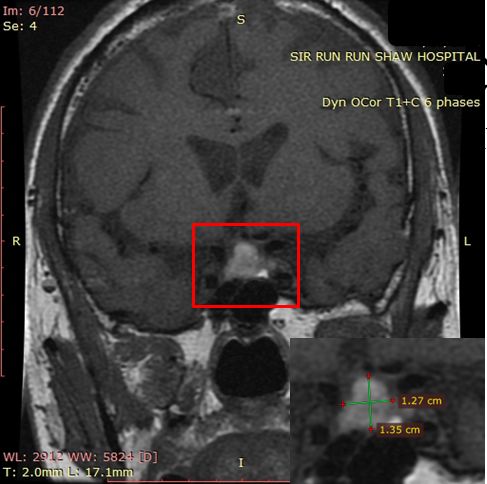 什么？！打嗝止不住是脑子有问题？