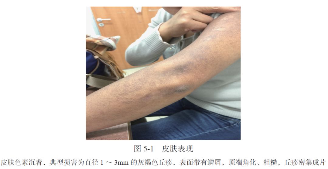 AIH、PBC、干燥综合征三者重叠合并原发性皮肤淀粉样变性1例|肝脏疾病疑难与经典病例(第四辑)