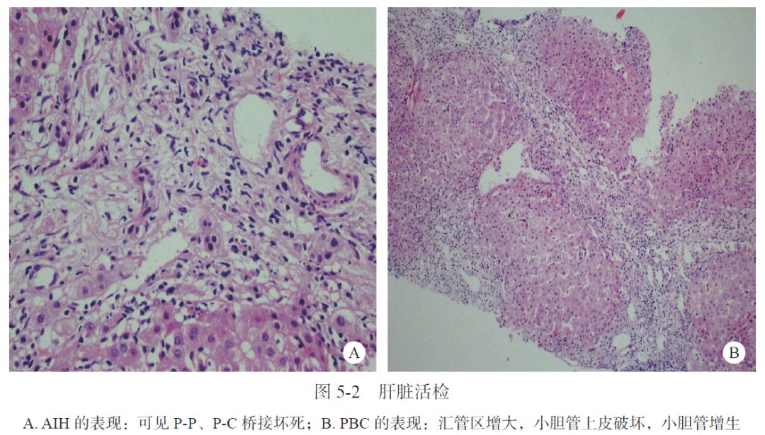 AIH、PBC、干燥综合征三者重叠合并原发性皮肤淀粉样变性1例|肝脏疾病疑难与经典病例(第四辑)