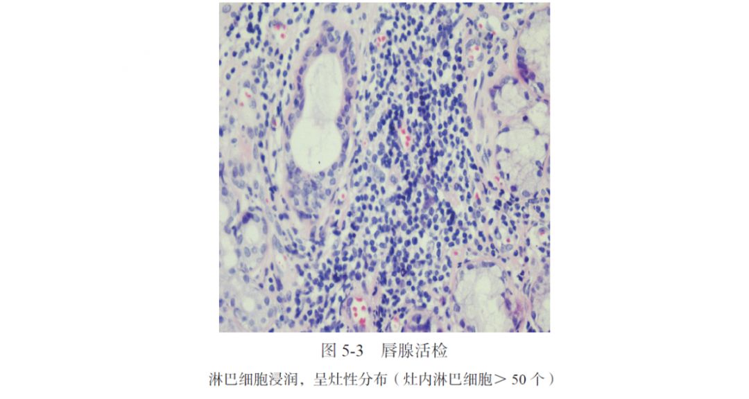 AIH、PBC、干燥综合征三者重叠合并原发性皮肤淀粉样变性1例|肝脏疾病疑难与经典病例(第四辑)
