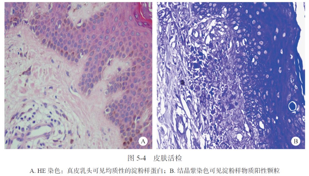 AIH、PBC、干燥综合征三者重叠合并原发性皮肤淀粉样变性1例|肝脏疾病疑难与经典病例(第四辑)