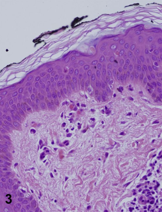 关节性紫癜会出现斑块吗,关节性紫癜有头疼症状吗
