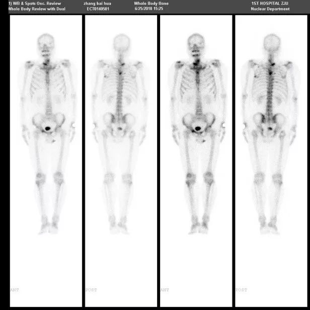 转移性内分泌治疗敏感性前列腺癌,抵抗性转移性前列腺癌