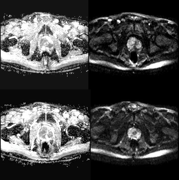 转移性内分泌治疗敏感性前列腺癌,抵抗性转移性前列腺癌