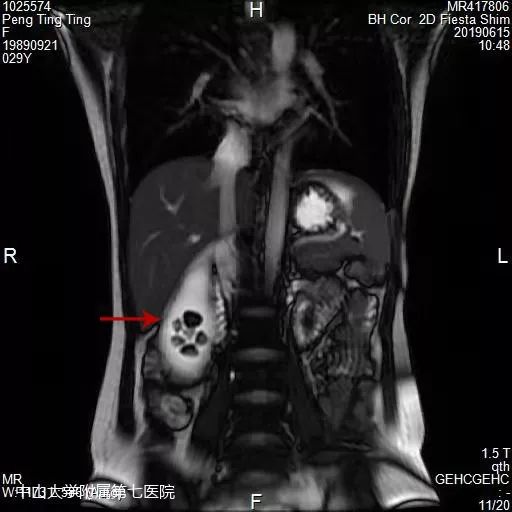 从微创到“隐创”！胆囊切除术只需在肚脐眼上开个小口