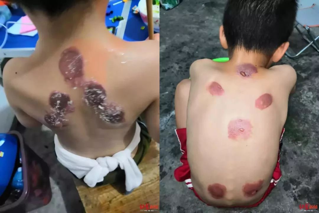 三伏贴卖不好的原因,三伏贴乱象调查