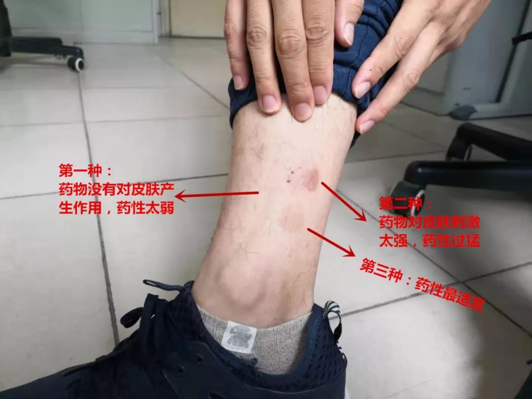 三伏贴卖不好的原因,三伏贴乱象调查