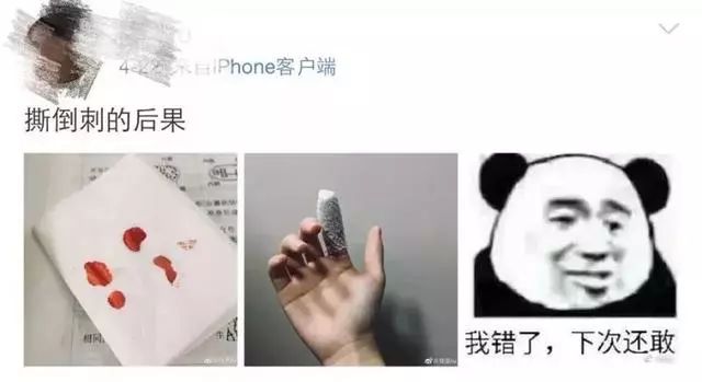 一个没注意，手指倒刺变截指！这个动作千万别再做了！