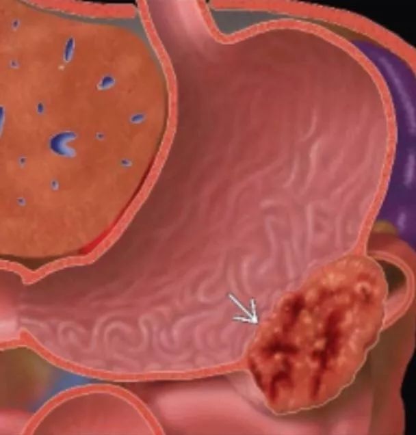 肠胃肿瘤肝转移啥状态,肝肿瘤转移胃