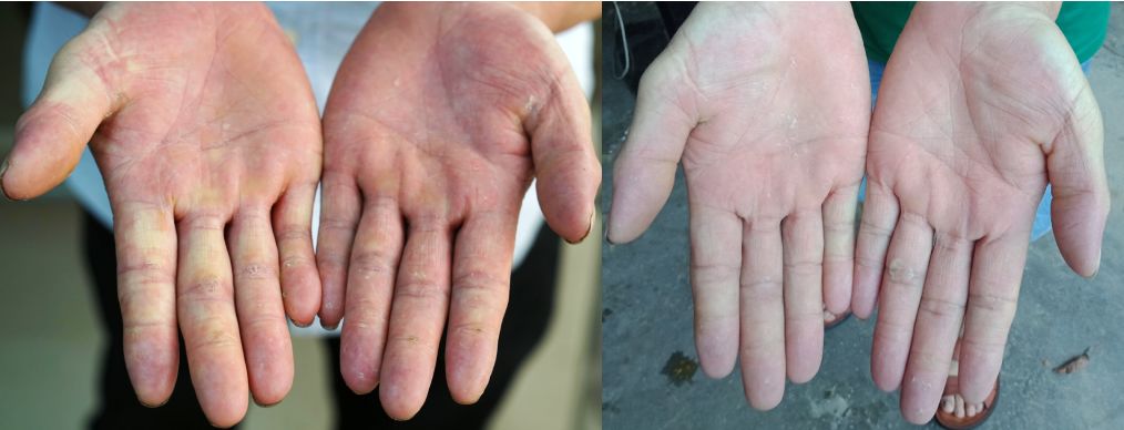 靶向药化疗对人体危害多大,肿瘤化疗毒副作用有哪些