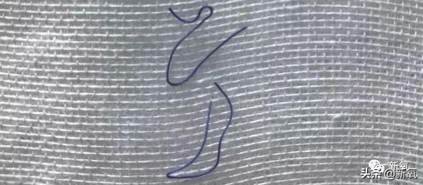 成都医美月▏为朋友埋线却被感染，体内40多根线，30多根都找不到了