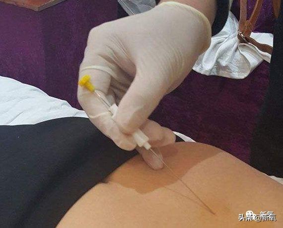 成都医美月▏为朋友埋线却被感染，体内40多根线，30多根都找不到了