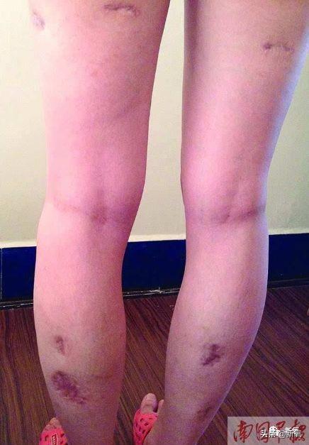 成都医美月▏为朋友埋线却被感染，体内40多根线，30多根都找不到了