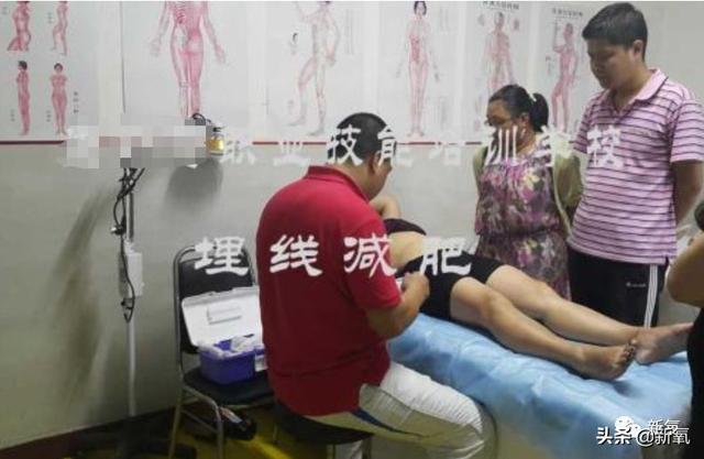 成都医美月▏为朋友埋线却被感染，体内40多根线，30多根都找不到了