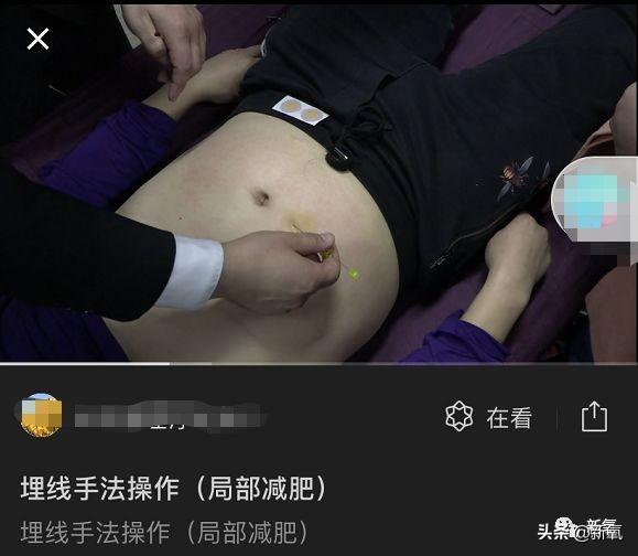 成都医美月▏为朋友埋线却被感染，体内40多根线，30多根都找不到了