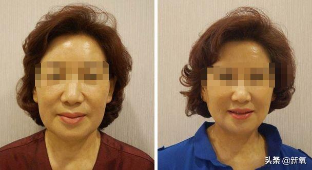 成都医美月▏为朋友埋线却被感染，体内40多根线，30多根都找不到了