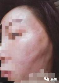 成都医美月▏为朋友埋线却被感染，体内40多根线，30多根都找不到了