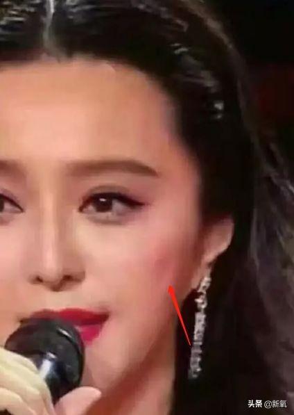 成都医美月▏为朋友埋线却被感染，体内40多根线，30多根都找不到了