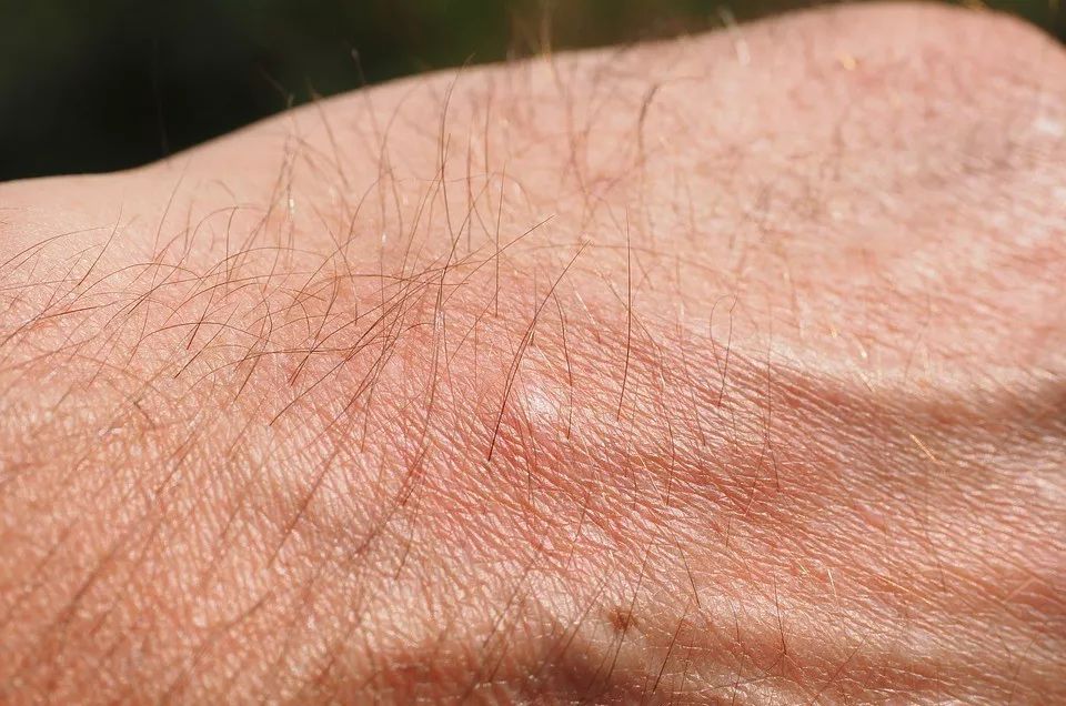 湿疹是体内湿气太重的原因,湿疹的原因是体内湿气太重吗