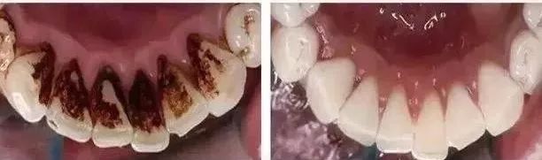 牙齿美白慕斯深层清洁,口臭牙黄去除神器