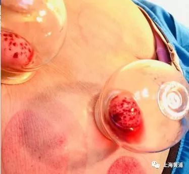 甩掉颈椎病肩周炎,甩掉肩周炎的运动