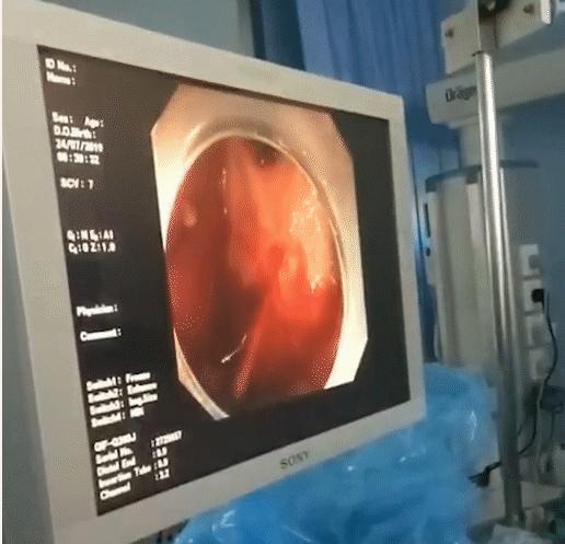 6人消化道大出血多学科救治演练,输血50000