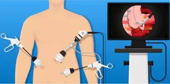 腹腔镜微创手术3d显示技术,3d腹腔镜和超高清腹腔镜