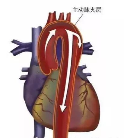警惕不定时炸弹主动脉夹层,警惕忽冷忽热易引爆主动脉夹层