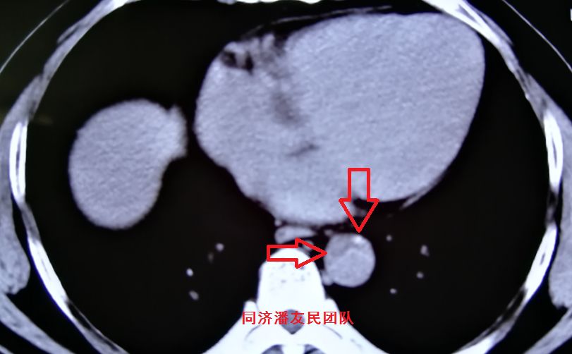 诊断主动脉夹层最简单有效的方法,心脏主动脉夹层是什么原因造成的