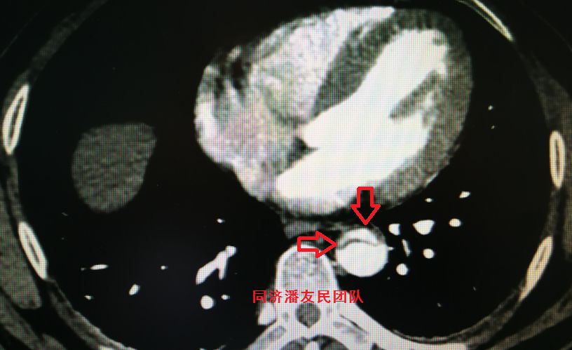 诊断主动脉夹层最简单有效的方法,心脏主动脉夹层是什么原因造成的