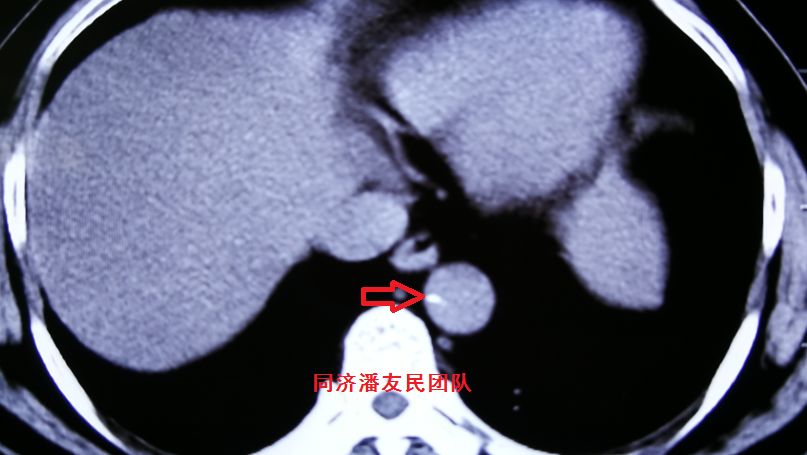 诊断主动脉夹层最简单有效的方法,心脏主动脉夹层是什么原因造成的